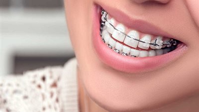  تمتع بأسنان جميلة.. كل ما تريد معرفته عن تقويم الأسنان وأنواعه وتكلفته