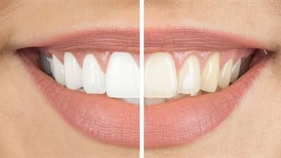 3 طرق فعالة لتبييض أسنانك بشكل طبيعي 