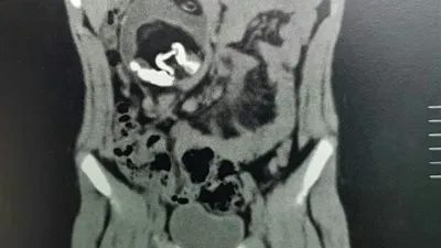 استخراج جنين من بطن طفل في الإسكندرية (صور)