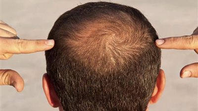 طبيب جلدية يصدم من يعانون الصلع: هذا علاجكم الوحيد (فيديو)