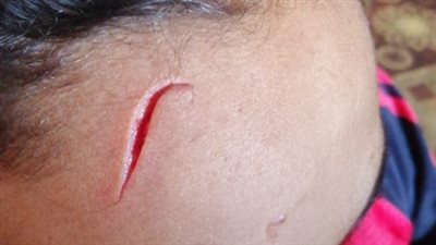 إصابة طالب إثر سقوط زجاج على رأسه بمدرسة في الغردقة