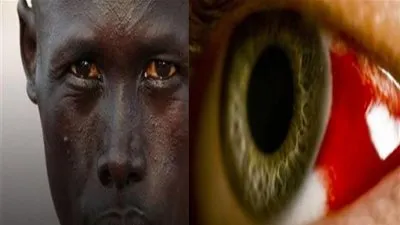 مرض غامض باثيوبيا يتسبب في رعب عالمي