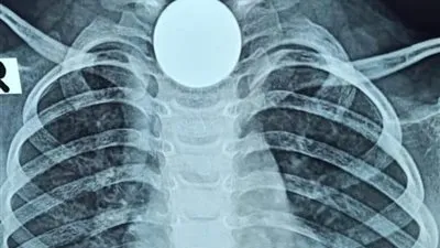 استخراج عملة معدنية من مريء طفلة بدون جراحة في المنصورة (صور)