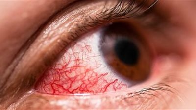 هل ينتقل كورونا عن طريق العين؟.. اعرف التفاصيل