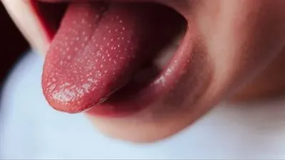 بعد تسجيل إصابات.. تعرف على طرق علاج مرض كاواساكي القاتل للأطفال