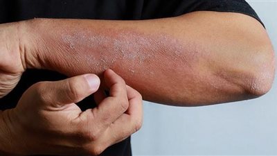 آخرها الطفح الجلدي.. قائمة بأحدث أعراض فيروس كورونا