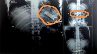 تفاصيل استخراج موبايل من معدة مريض بعد بقائه 7 شهور   