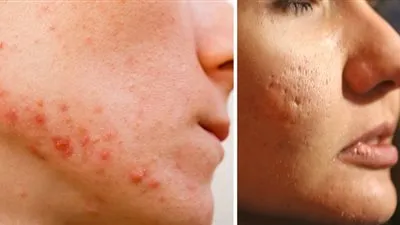 تعرف على وصفات للتخلص من مشاكل البشرة بواسطة الطماطم