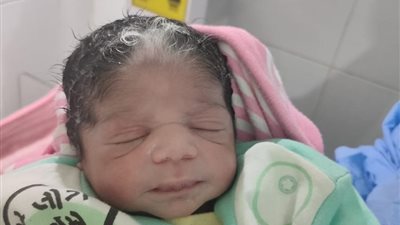 طبيب يكشف سبب ولادة طفلة بخصلات شعر بيضاء في الأقصر (فيديو)