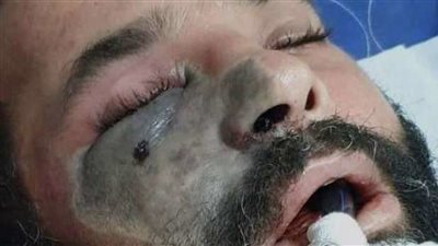 بينها الصداع والزغللة.. تعرف على أعراض الفطر الأسود (فيديو)