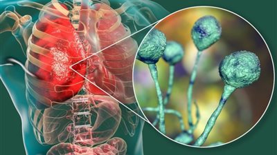 توضيح هام من وزارة الصحة بشأن الفطر الأسود