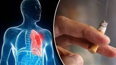 أستاذ حساسية: 85% من سرطان الرئة سببه التدخين (فيديو)