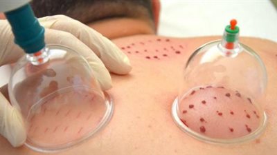 مشادة ساخنة على الهواء بين أستاذ بجامعة القاهرة ومعالجة بالحجامة (فيديو)