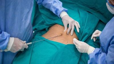 استشاري: الفيزر تقنية جديدة لشفط الدهون (فيديو)