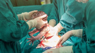 أطباء يحذرون من الولادة القيصرية: 