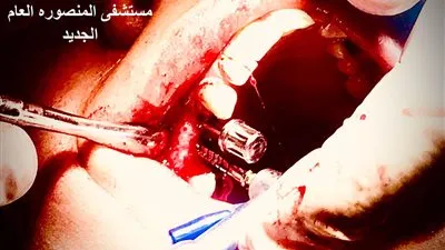 مستشفى المنصورة الدولي يعلن إجراء أول جراحة زراعة أسنان 