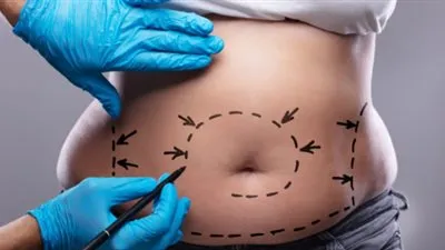 طبيب: 100% نسبة عدم حدوث تسريب أو نزيف في جراحات السمنة (فيديو)