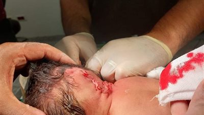  نجاح عملية نادرة بالمخ لرضيع في مستشفى ملوي التخصصي