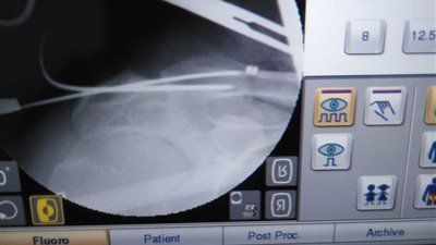 نجاح اول عملية تثبيت خلع بمفصل الكتف بتقنية جديدة بمستشفى دكرنس العام