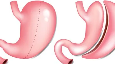 استشاري: تقصف الشعر وشحوب الوجه بعد إجراء التكميم ليس عيبًا في العملية (فيديو)