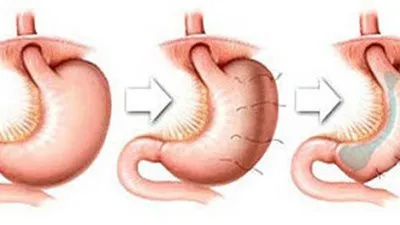 استشاري: تكميم المعدة تصلح في العمر الصغير (فيديو)