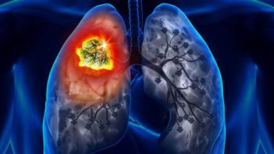 في اليوم العالمي للرئتين.. كيف تحمي نفسك من الإصابة بسرطان الرئة؟