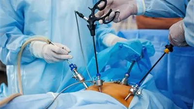 استشاري: عملية تكميم المعدة تستمر العمر كله في هذه الحالة (فيديو)