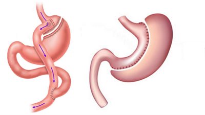 استشاري: يُفضل إجراء عملية التحويل المصغر في هذه الحالة (فيديو)