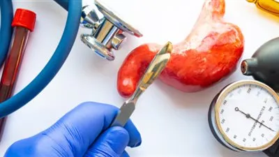 استشاري: عملية تكميم المعدة تفضل في السن الصغير لهذا السبب (فيديو)