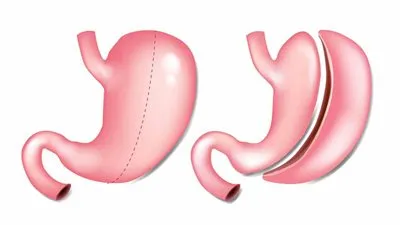 استشاري: هناك ضرورة لتجهيز المريض نفسيًا لإجراء تكميم المعدة (فيديو)