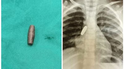 إنقاذ طفلة ابتلعت طلقة خرطوش في المنيا (صورة)