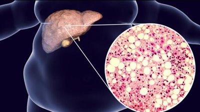 محمد عز العرب: 30% من السكان عالميًا يعانون من دهون على الكبد