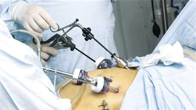 استشاري: عملية التكميم لا تصلح لهذه الفئة من مرضى السمنة (فيديو) 