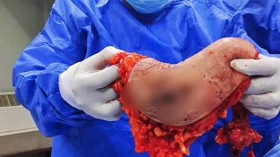 فريق جراحة بمستشفى السويس العام ينجح في استئصال أورام سرطانية من الثدي