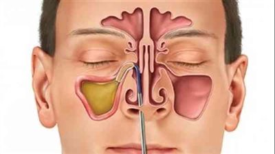 نصائح لمرضى الجيوب الأنفية خلال الطقس السيئ