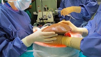 أستاذ جهاز هضمي: معدلات زراعة الكبد انخفضت بمصر لهذا السبب