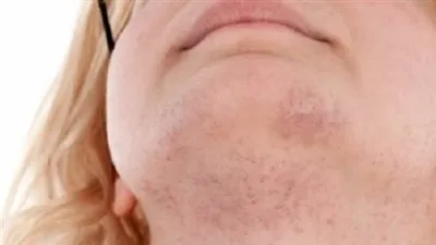 أخصائية تغذية تكشف سبب ظهور الشعر لدى السيدات في أماكن غير مرغوبة (فيديو)