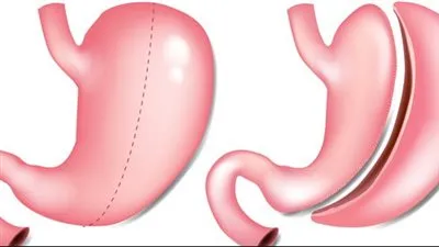 استشاري: عملية التكميم الإجراء المناسب حال زيادة سمك جدار المعدة (فيديو)
