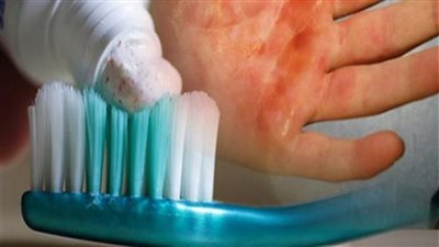 رئيس تمريض الحالات الحرجة تحذر من وضع معجون الأسنان على الحروق (فيديو)