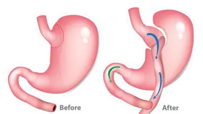 استشاري: تحويل المسار تعالج السكر بشكل جذري 