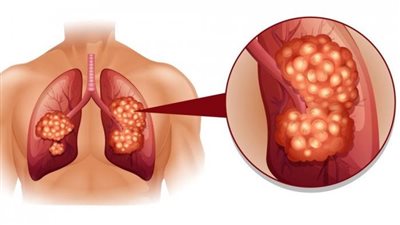 باحث مصري بألمانيا يصمم خريطة مفاتيح للجسم للتحكم فى الأورام السرطانية