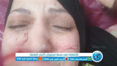 شوه وجهها.. ننشر الصور الأولى للسيدة ضحية الاعتداء على يد طليقها بكرداسة