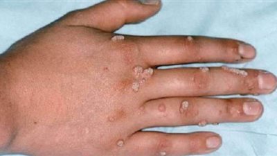 بعد رصد أول إصابة.. ما لا تعرفه عن فيروس جدري القرود