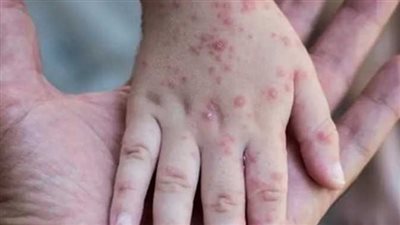 من أمريكا لإسرائيل.. 8 دول بارزة سجلت إصابات بجدري القرود