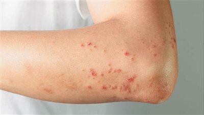 هاني الناظر: جدري القرود ينتقل عبر الاتصال المباشر وليس عبر مسافات طويلة (فيديو)