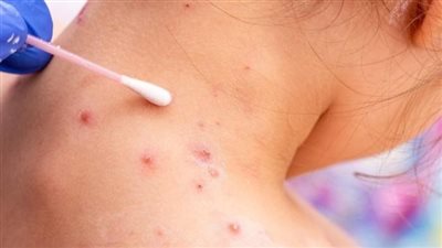 الصحة تكشف حقيقة وجود حالات مصابة بجدري القرود في مصر