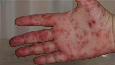 أستاذ مناعة يكشف تفاصيل جديدة بشأن فيروس 