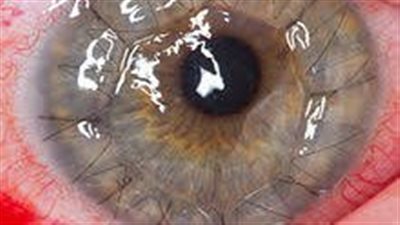 برلماني: 20 ألف حالة تحتاج لزرع القرنيات في قوائم الانتظار