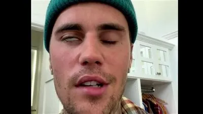 جاستن بيبر يعلن إصابته بشلل في وجهه