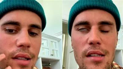 ما هي متلازمة رامزي هانت؟